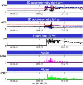 Tele-Epilepsy and Remote Seizure Monitoring (Data 2)